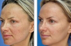 Laserpeeling