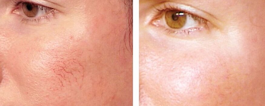 Verwijdering van rosacea