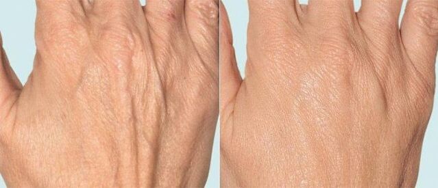 Handhuid voor en na fractionele therapie