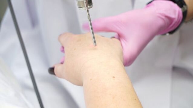 Laser handhuidverjonging